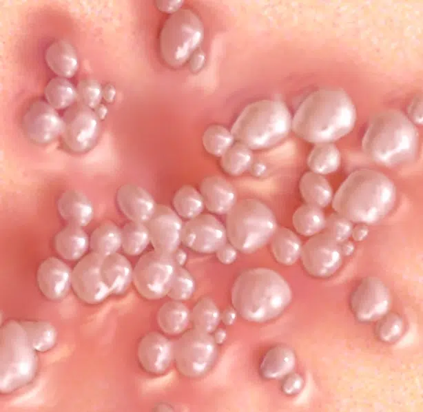 بهترین قرص برای تبخال تناسلی